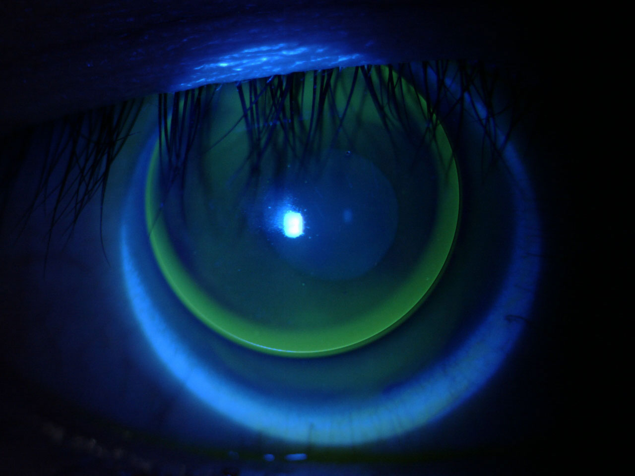 Rigid Gas Permeable Lenses (RGP Lens or GP Contact Lens) Contact Lens | 1 Hard Lens