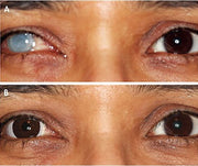 Silklens Prosthetic D-Type Center Pupil Black Contact Lens (1 Lens)